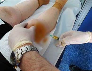 Yaşam’da PRP Uygulaması Başladı
